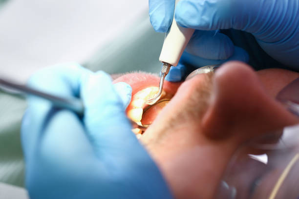 Best Emergency Wisdom Tooth Extraction in Portland, TX